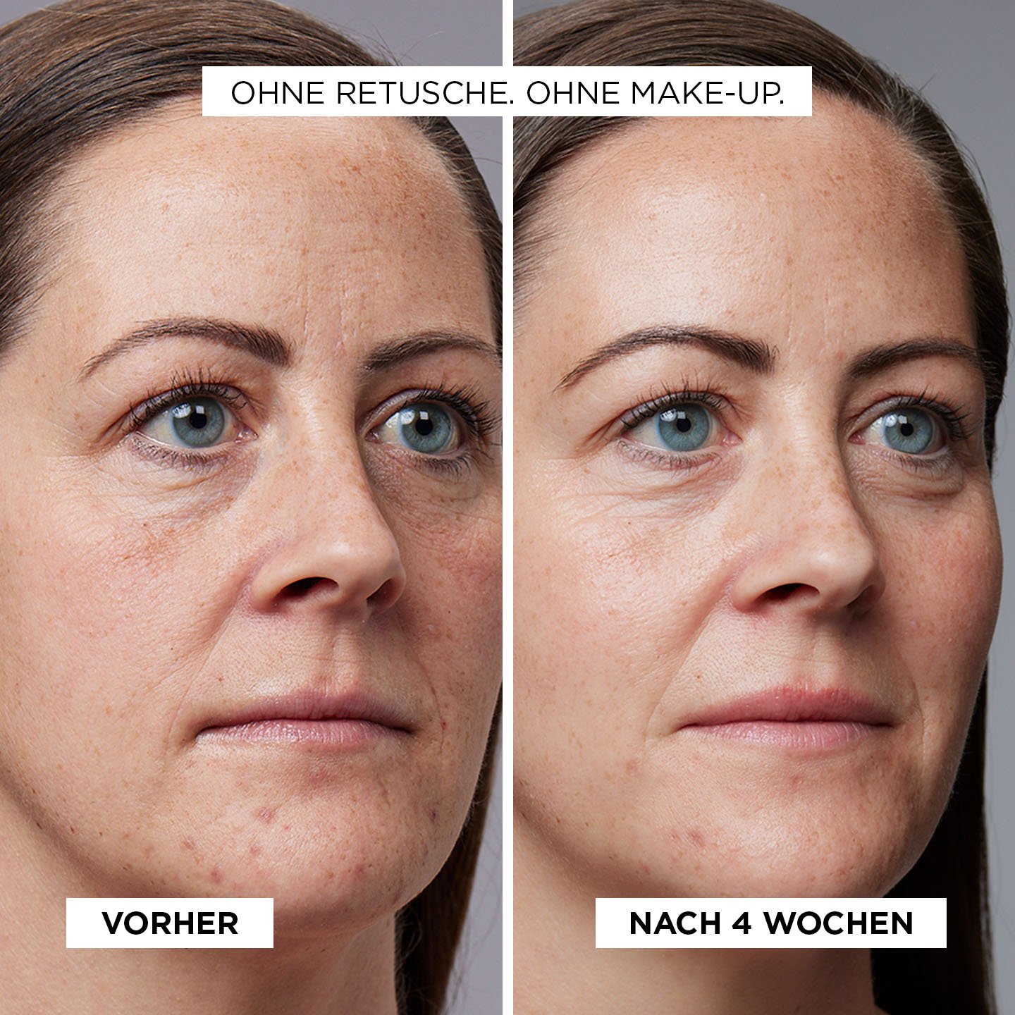 Revitalift Laser X3 Vorher Nachher